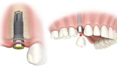 7 Factors to Know When You Get Dental Implants