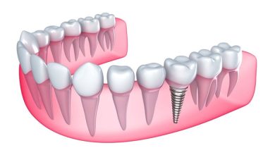 Dental İmplantlar