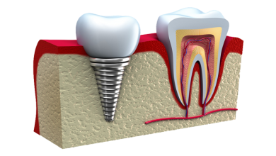 Dental İmplantlar