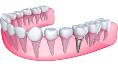 Diş Hekimliğinde İmplant Tedavisi