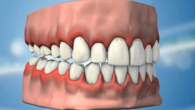 Dişeti Hastalıkları Tedavisi(Periodontoloji) Nedir?