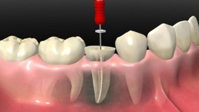 Endodonti (Kanal Tedavisi)