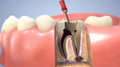 Endodonti (Kanal Tedavisi)?