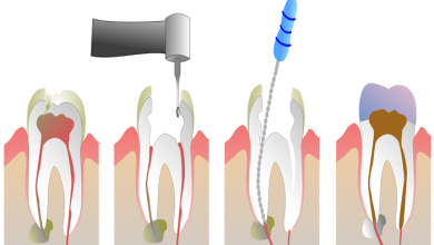 Endodonti Kanal Tedavisi