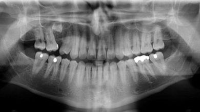 Hangi sıklıkla diş röntgenleri çektirmeliyim?
