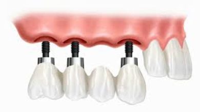 İmplant Tedavisi Hangi Durumlarda Tercih Edilmelidir? Nasıl Uygulanır?