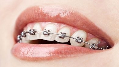 Invisalign Ortodonti Sistem