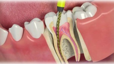 Kök Kanalı Tedavisi – Endodontik Tedavi