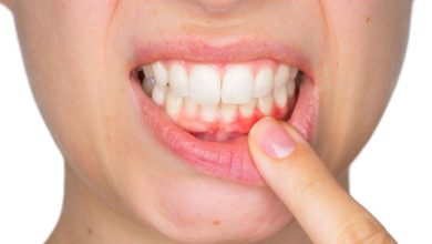 Periodontitis Nedir? Gingivitis Nedir?